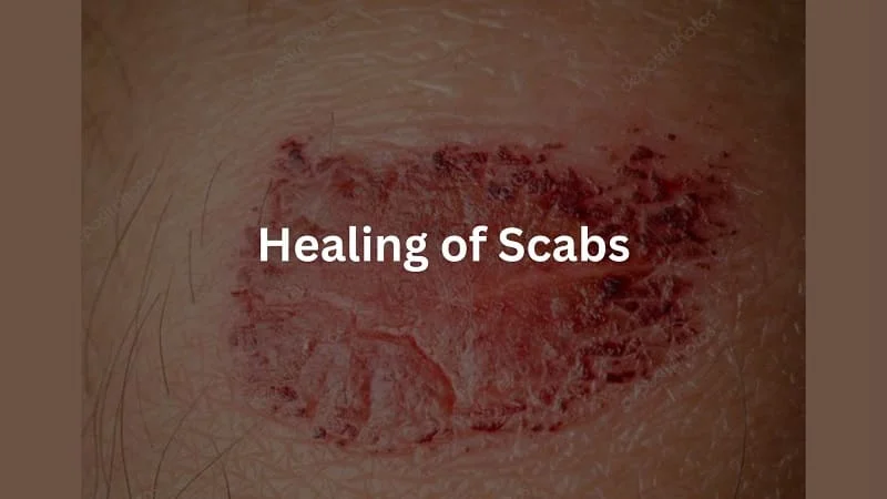 scabs heal faster dry or moist