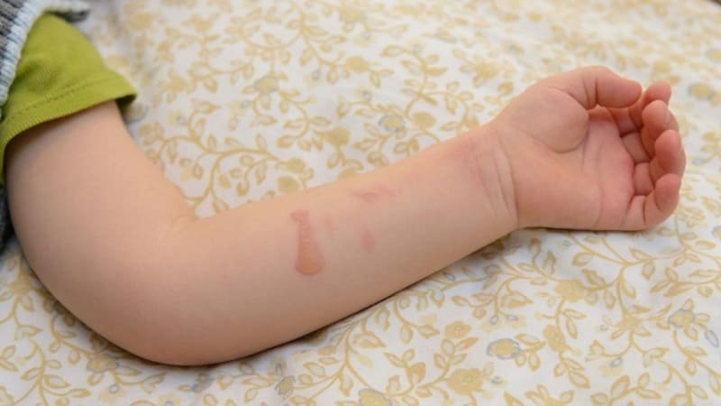 How to treat hot water burn on baby – First Aid