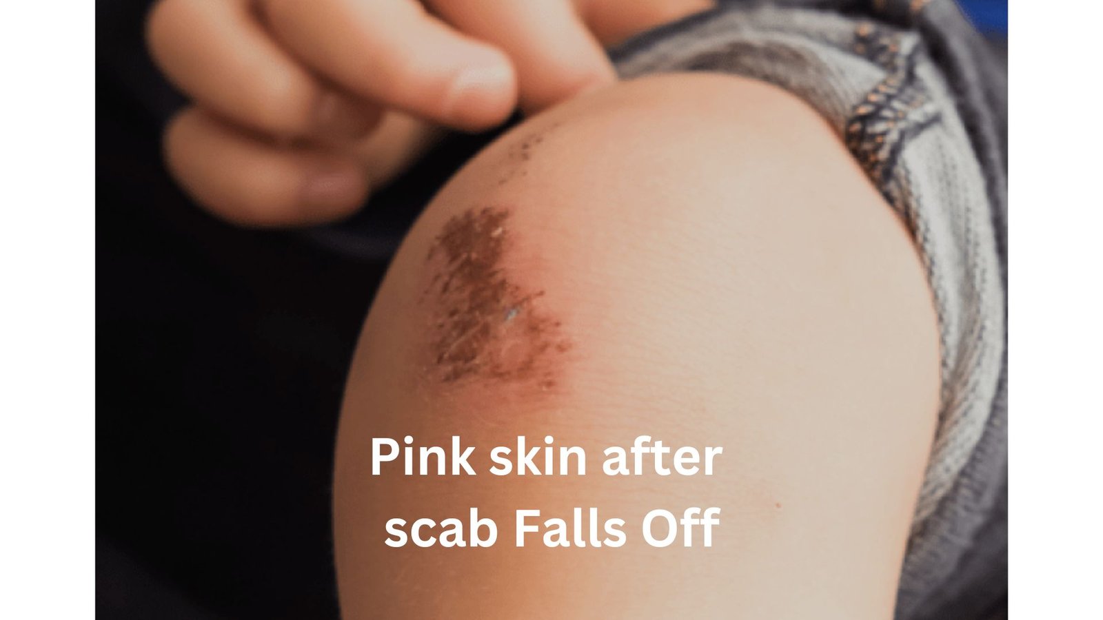 Treat pink skin after scab falls