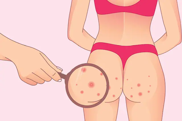 Acne on the buttocks home remedies