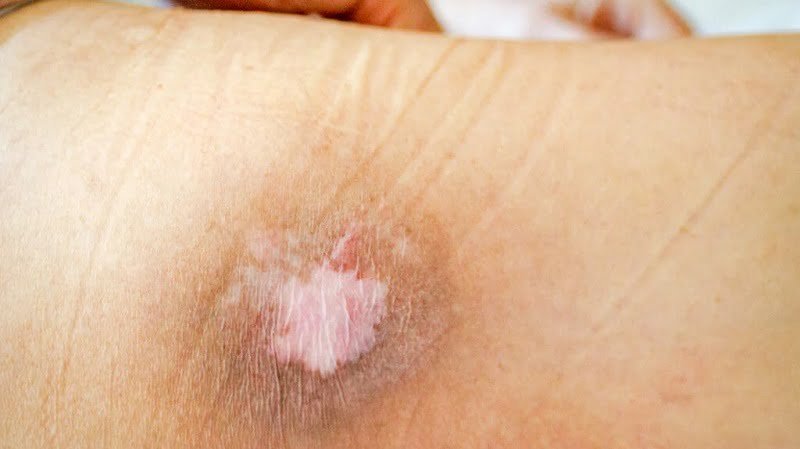 Will pink skin under scab go away