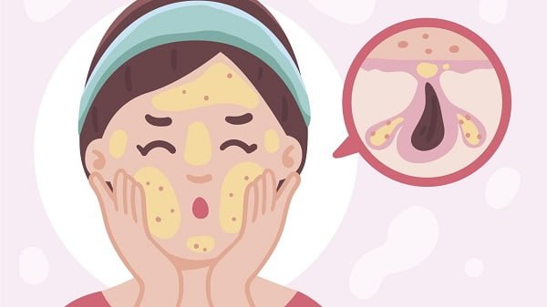 Clog Pores can cause acne formation