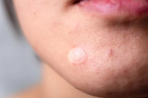 Do pimple patches work on hormonal acne