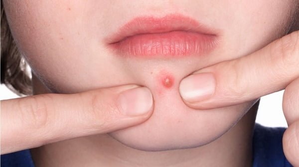 Does acne spread if popped