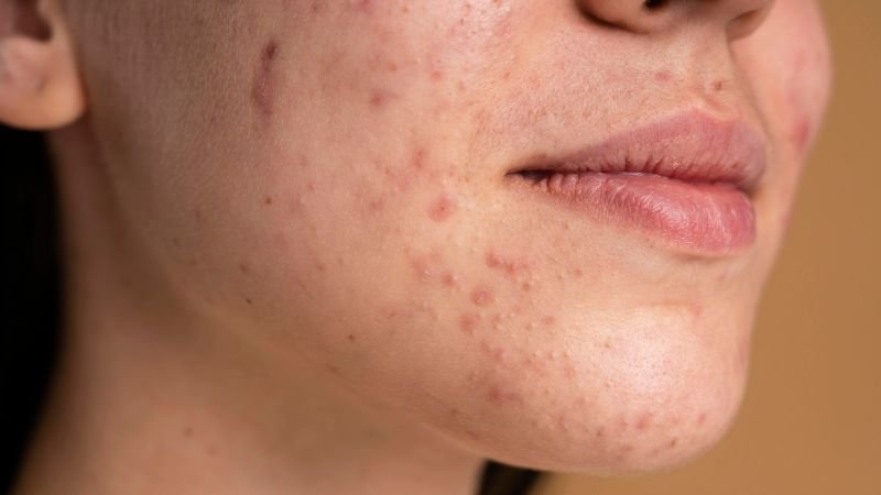 Hormonal cystic acne treatment at home