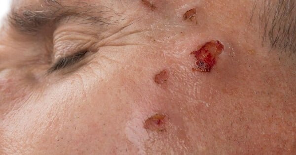 How to make scabs heal faster on face