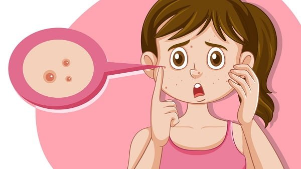How to remove a blackhead that won't come out