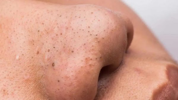 How to remove deep blackheads on nose at home