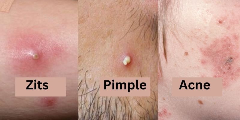 acne vs pimples vs zits