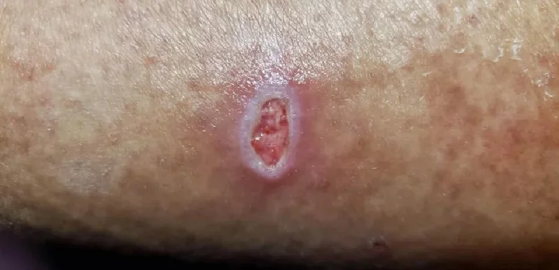 Scab fell off left a hole