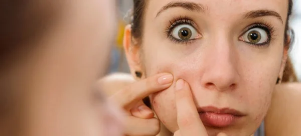 What causes acne in females