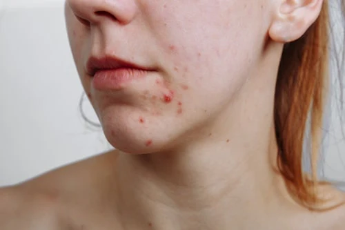 What skin problem can Propionibacterium acnes cause