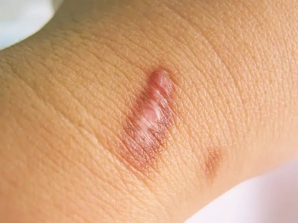What to put on wound after scab falls off