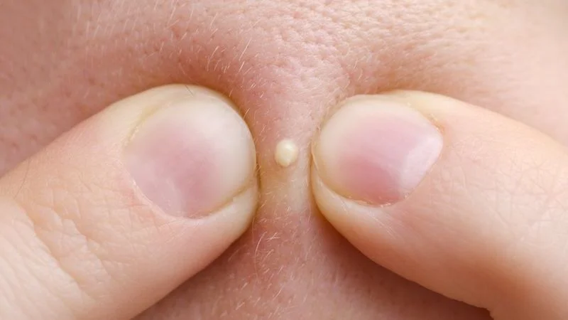 Where does the pus go if you don't pop a pimple