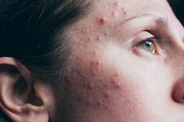 can someone with acne give you acne