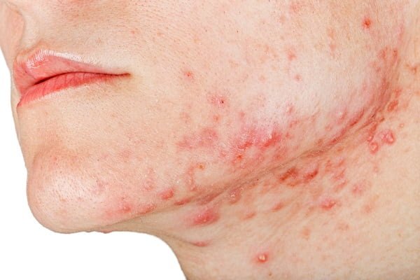 what causes acne around jawline and neck