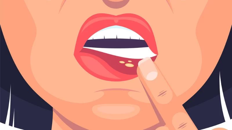 what is a mucous cyst on lip