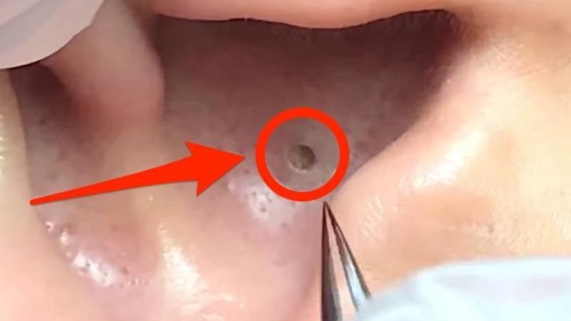 What causes blackheads in ear
